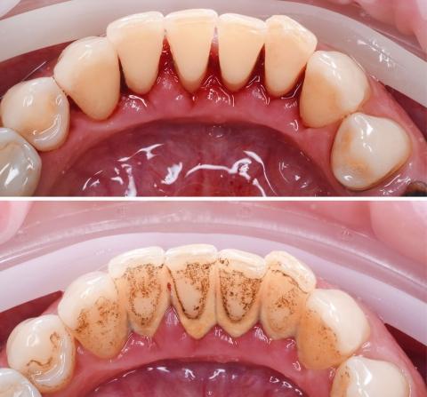 Kezelés előtt és után