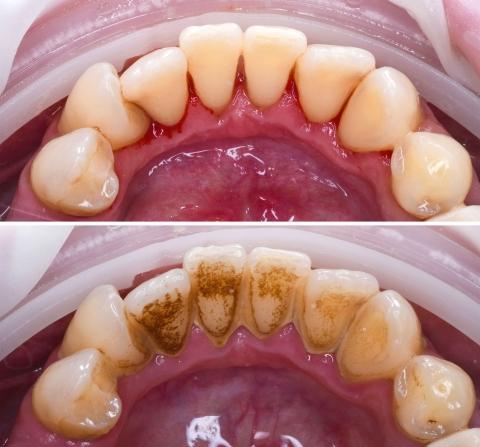 Kezelés előtt és után