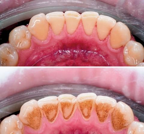 Kezelés előtt és után