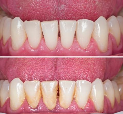 Kezelés előtt és után