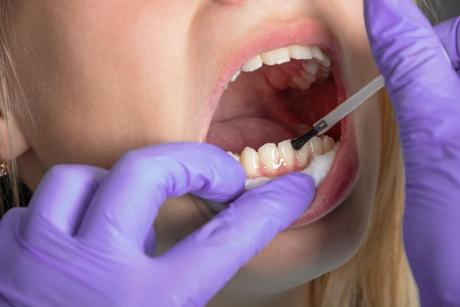Fluoridos zománcregeneráló bevonat